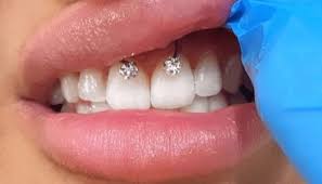 Révélation du Piercing Smiley : Tout Ce Que Vous Devez Savoir !